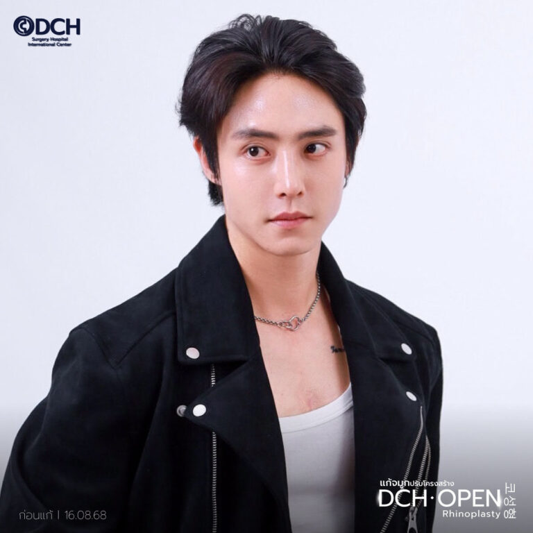 คุณฮิม 14 หลังแก้จมูก-2