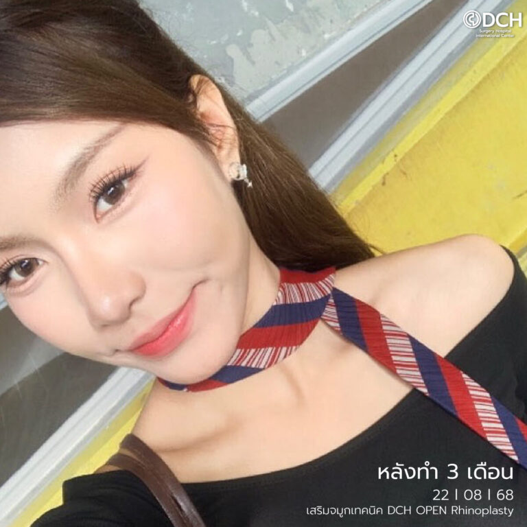 คุณอองออล หลังเสริมจมูก1