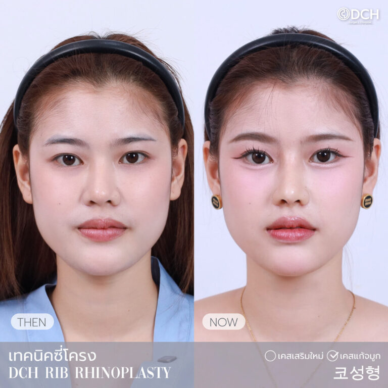 แก้จมูกซี่โครง