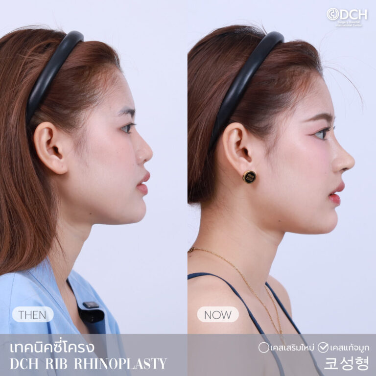 แก้จมูกซี่โครง