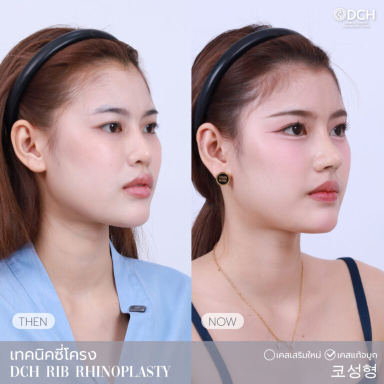 แก้จมูกซี่โครง