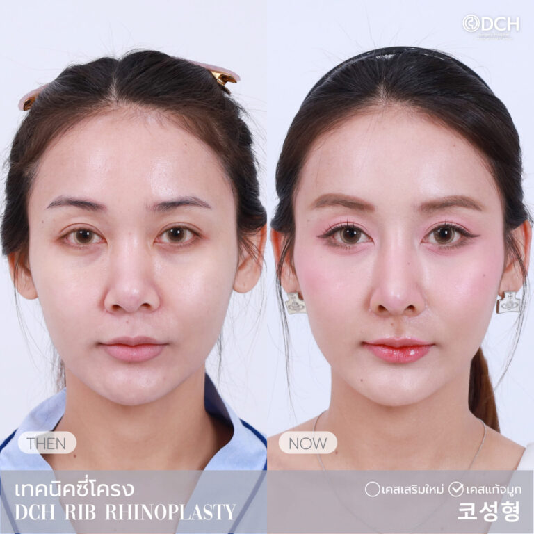 แก้จมูกซี่โครง