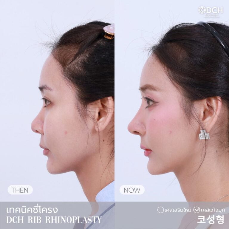 แก้จมูกซี่โครง