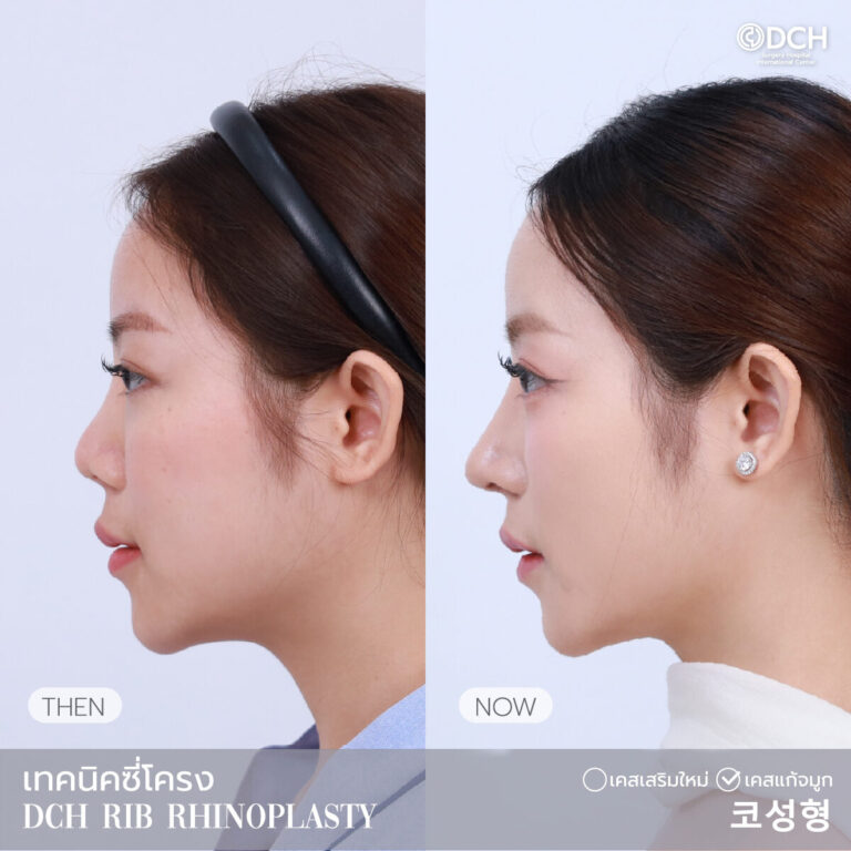 แก้จมูกซี่โครง