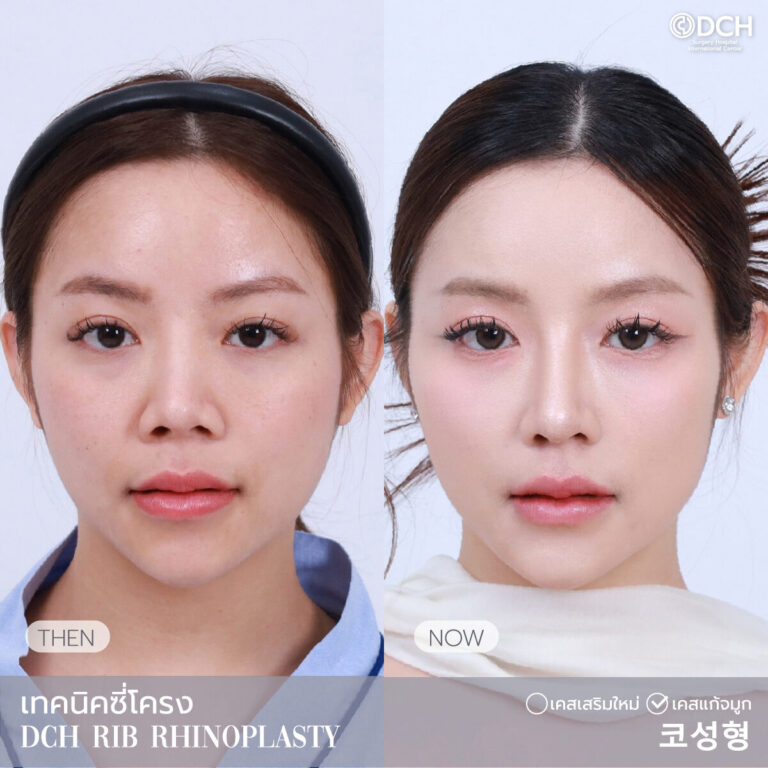 แก้จมูกซี่โครง