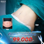 ตัดหนังหน้าท้อง