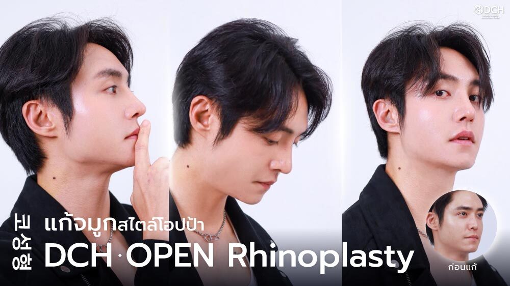 ปกบทความแก้จมูกคุณฮิม-14-วัน