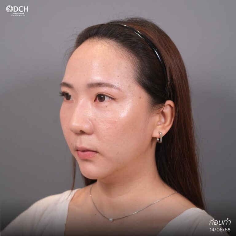 แก้จมูกคุณแนนก่อนทำ