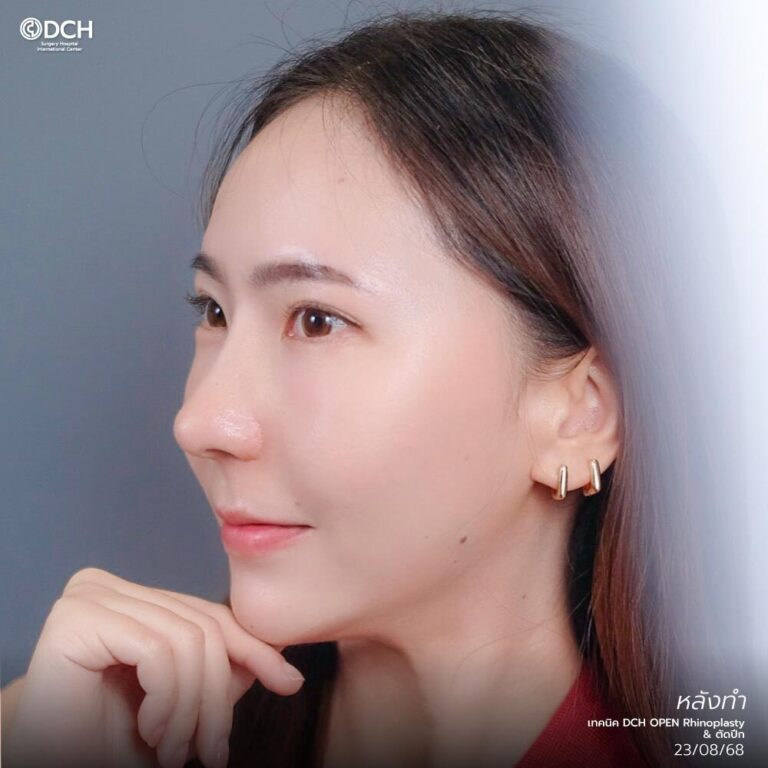 แก้จมูกคุณแนนหลังทำ-1