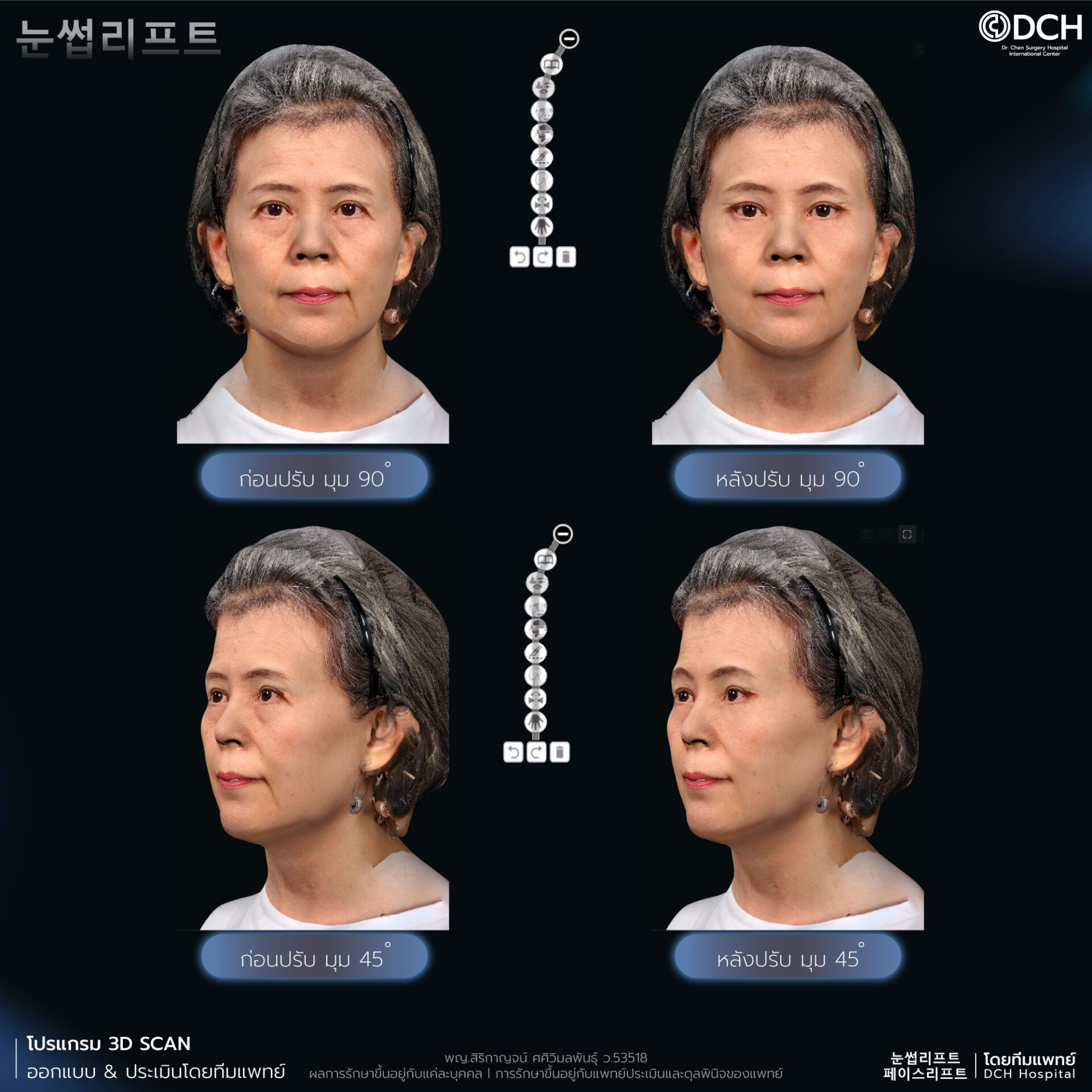 ดึงหน้า