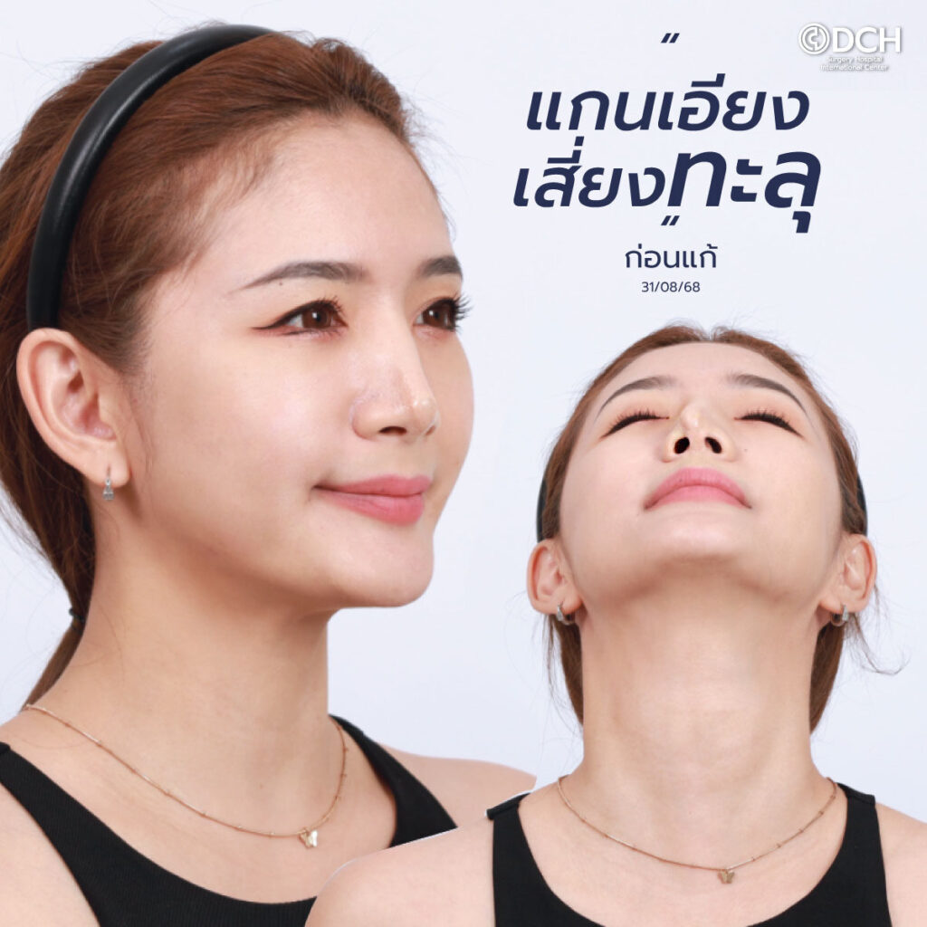 แก้จมูก