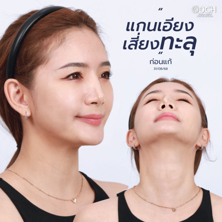 แก้จมูก