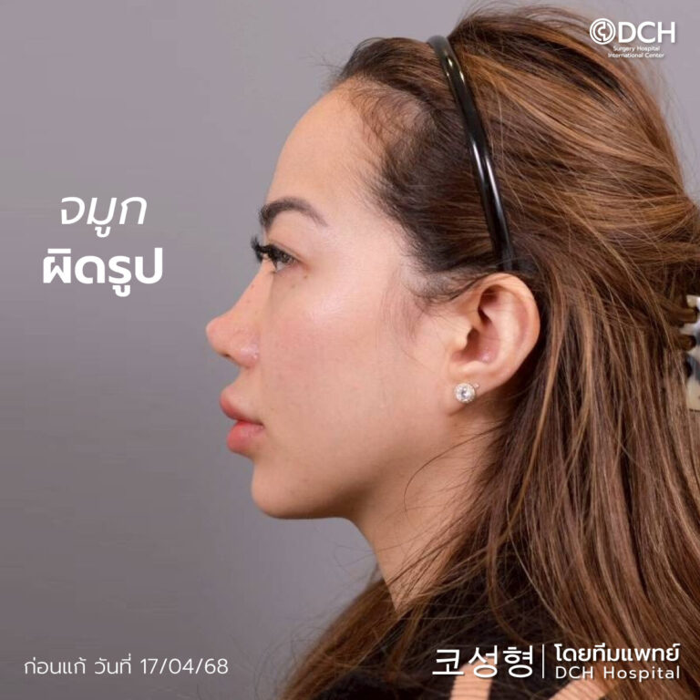 แก้จมูกซี่โครงคุณยูกิ-ก่อนทำ