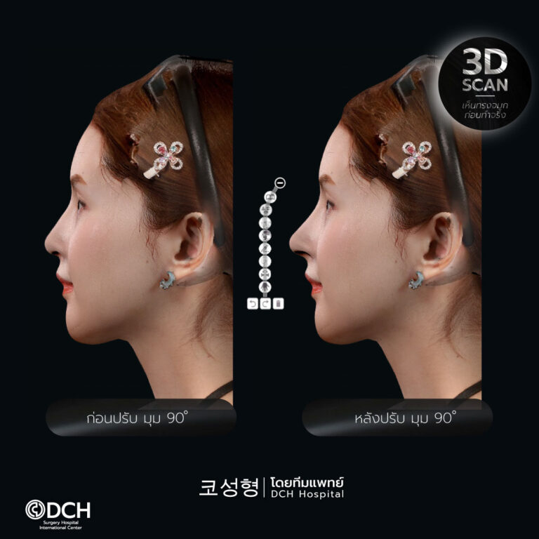 เบียร์-เดอะวอยซ์เสริมจมูกซี่โครง-3d