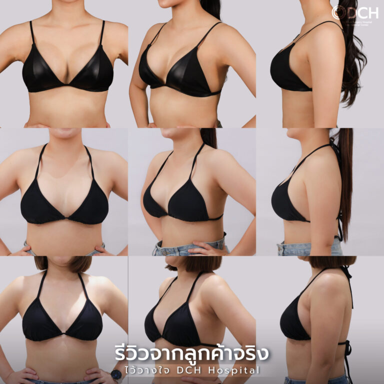 Web-รีวิวเสริมหน้าอก-3-แถว-01