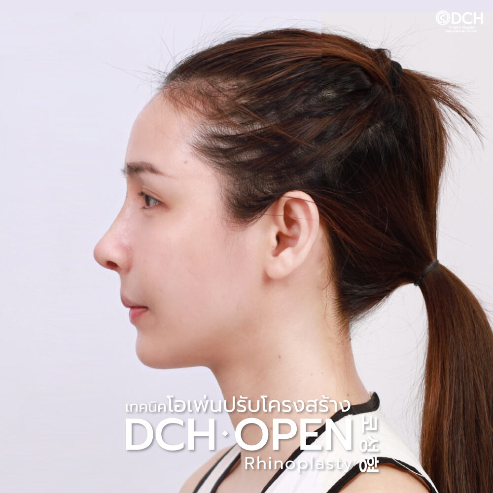 ผู้รับบริการหลังเสริมจมูกเทคนิค DCH Open Rhinoplasty ปรับโครงสร้าง มุมด้านข้าง