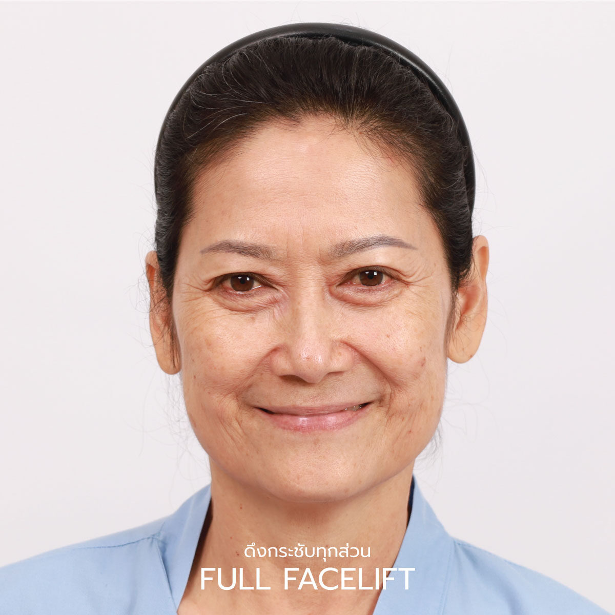 ดึงหน้า Full Facelift
