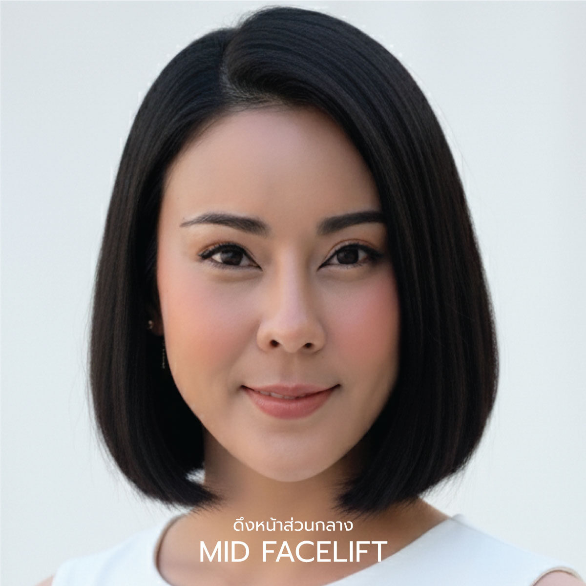 ดึงหน้า Mid Facelift