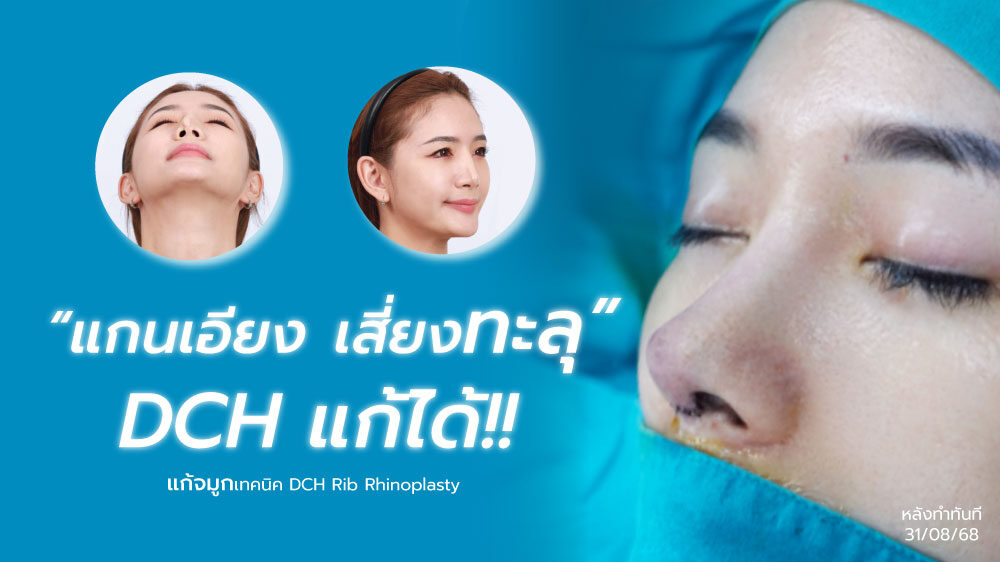 ปกบทความคุณโม-แก้จมูกซี่โครง