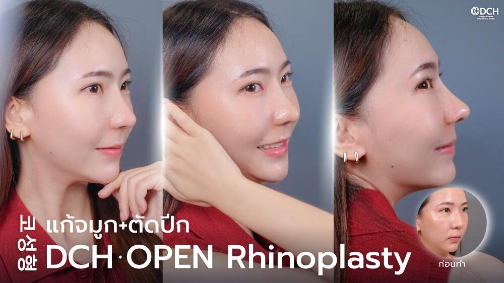 ปกบทความรีวิวแก้จมูกโอเพ่นคุณแนน