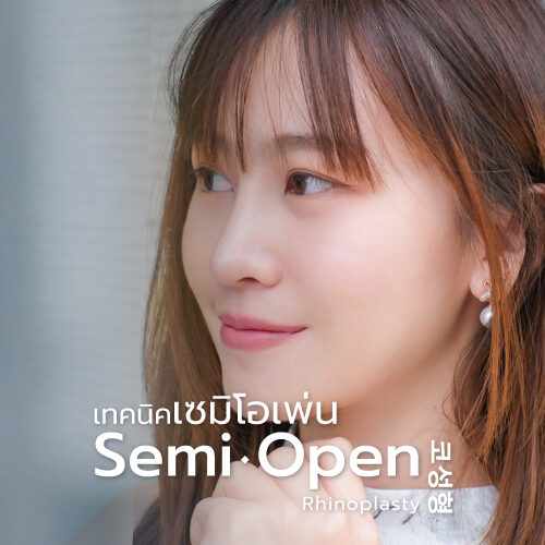 DCH Semi-Open Rhinoplasty