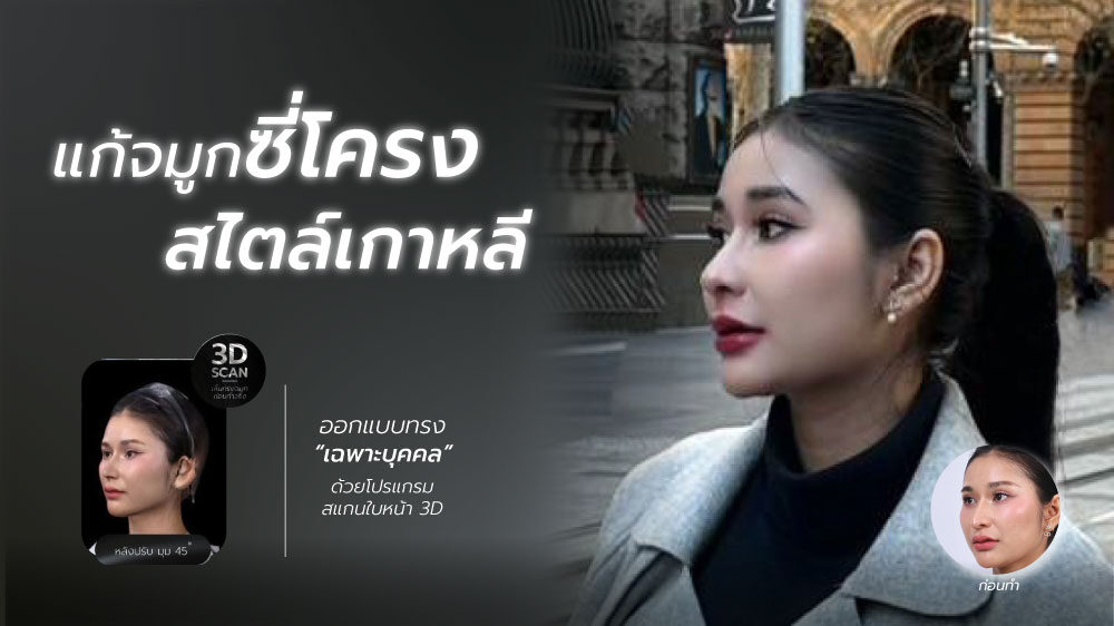 แก้จมูกซี่โครงคุณเจนนี่ครบ3เดือน