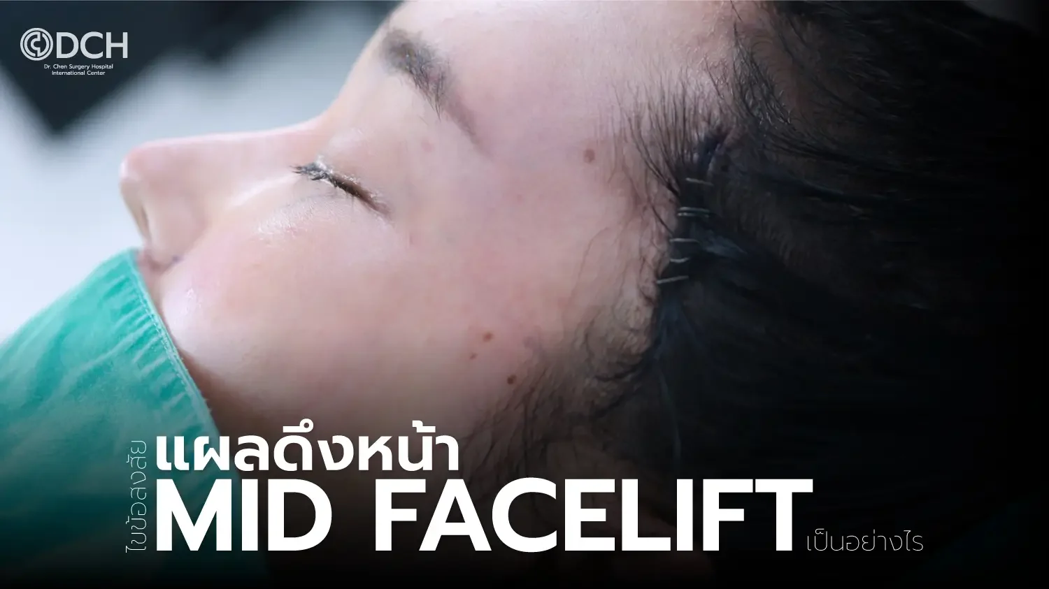 Mid Facelift