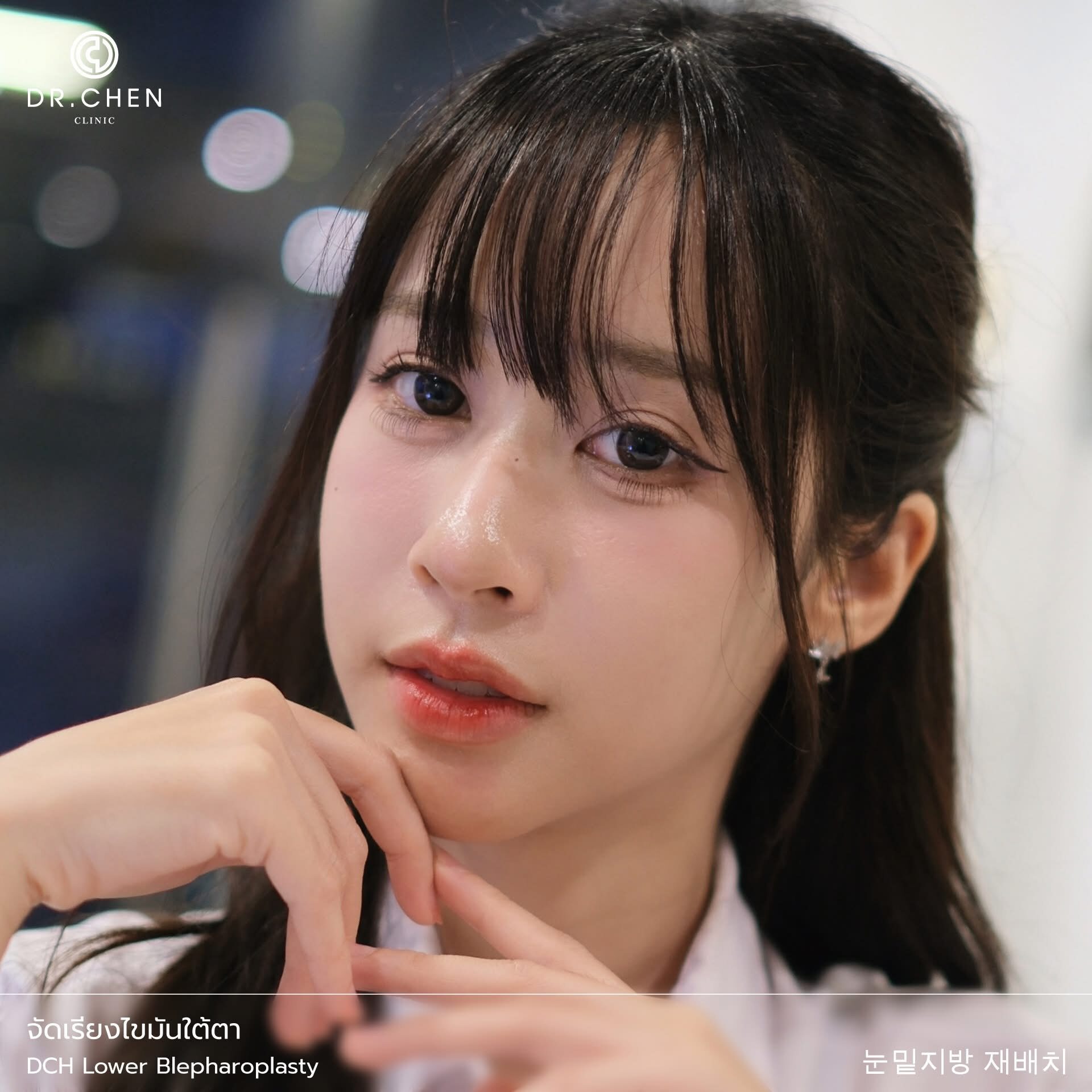 จัดเรียงไขมันใต้ตา