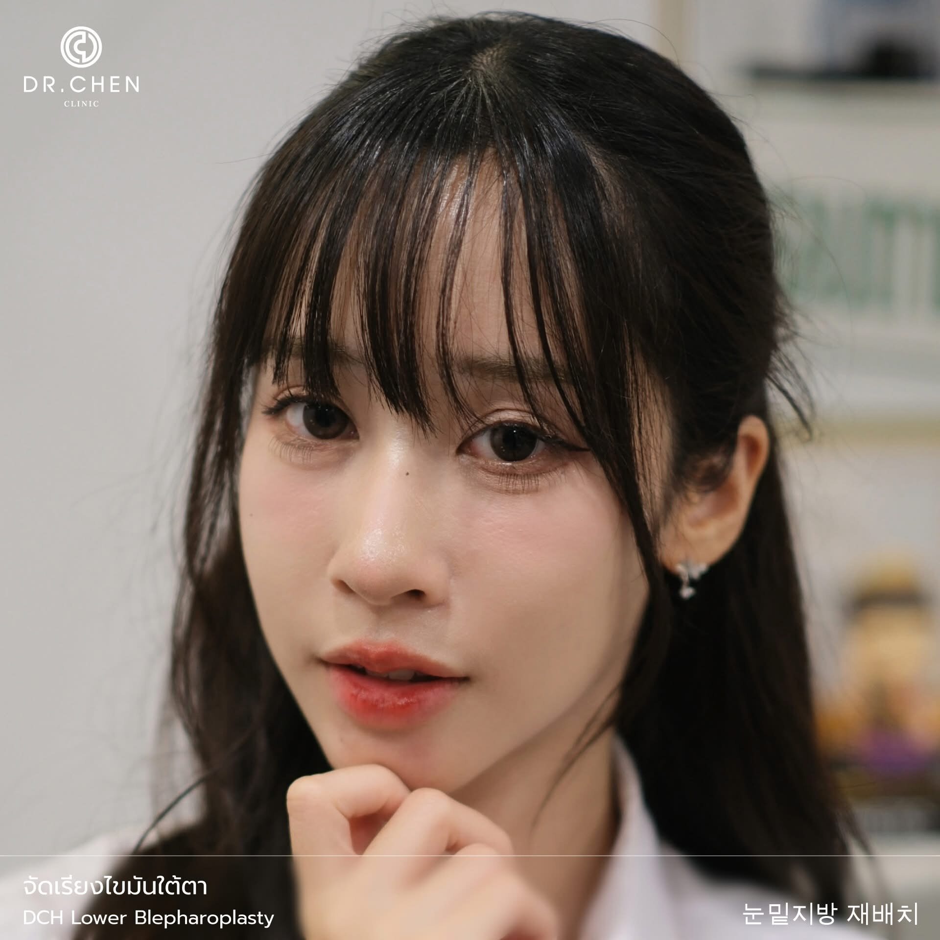 จัดเรียงไขมันใต้ตา
