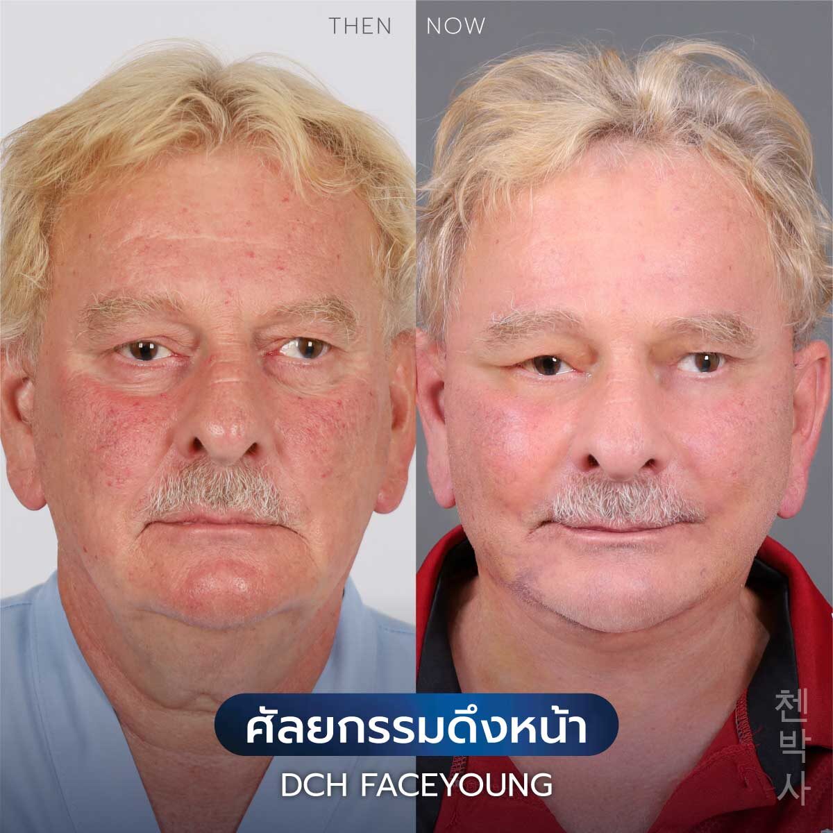 ดึงหน้าผู้ชาย