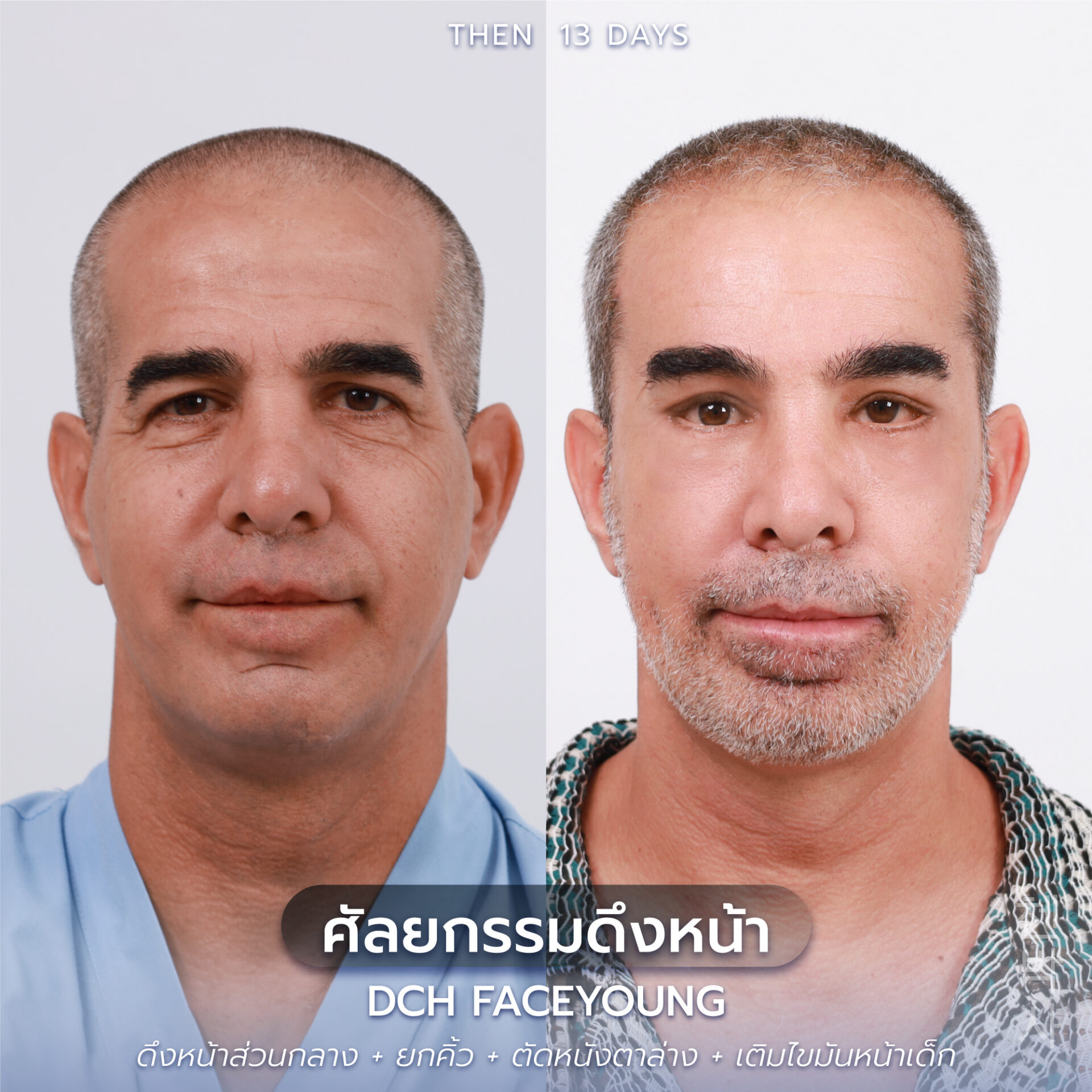 ดึงหน้าผู้ชาย