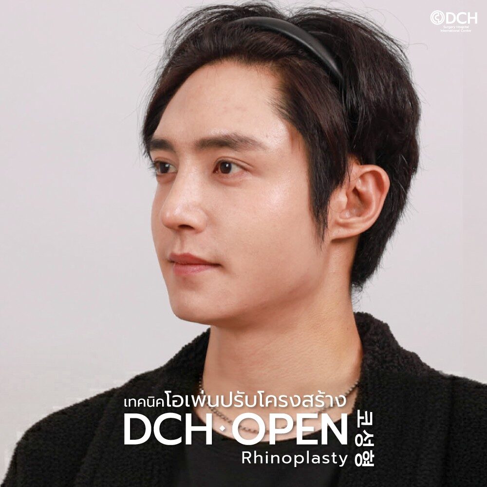 Rhinoplasty-Nose-manB-A11