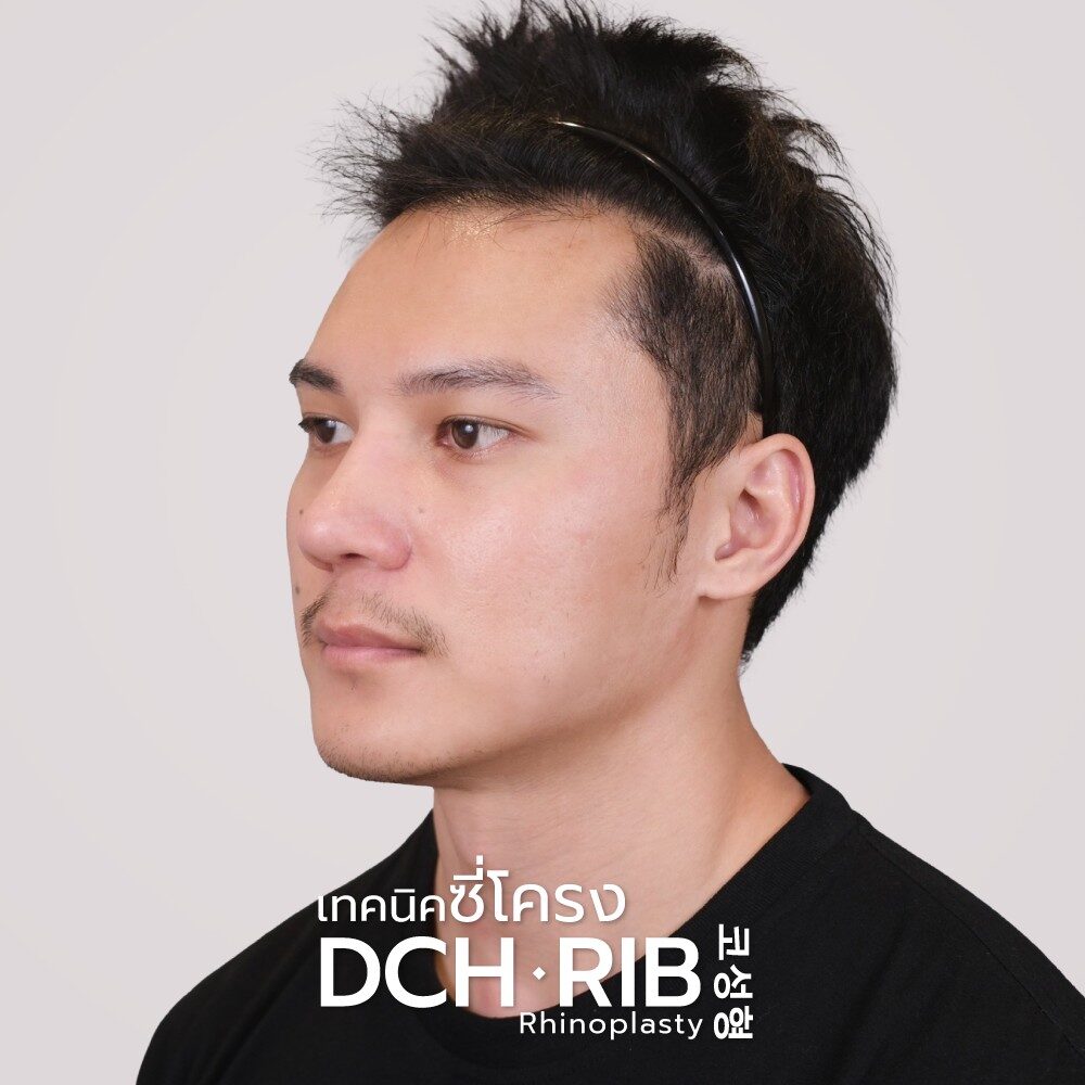 Rhinoplasty-Nose-manB-A3