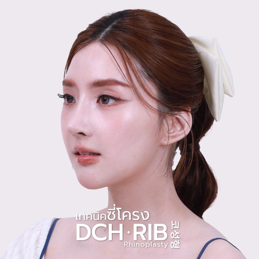 Rhinoplasty-Nose-manB-A7772