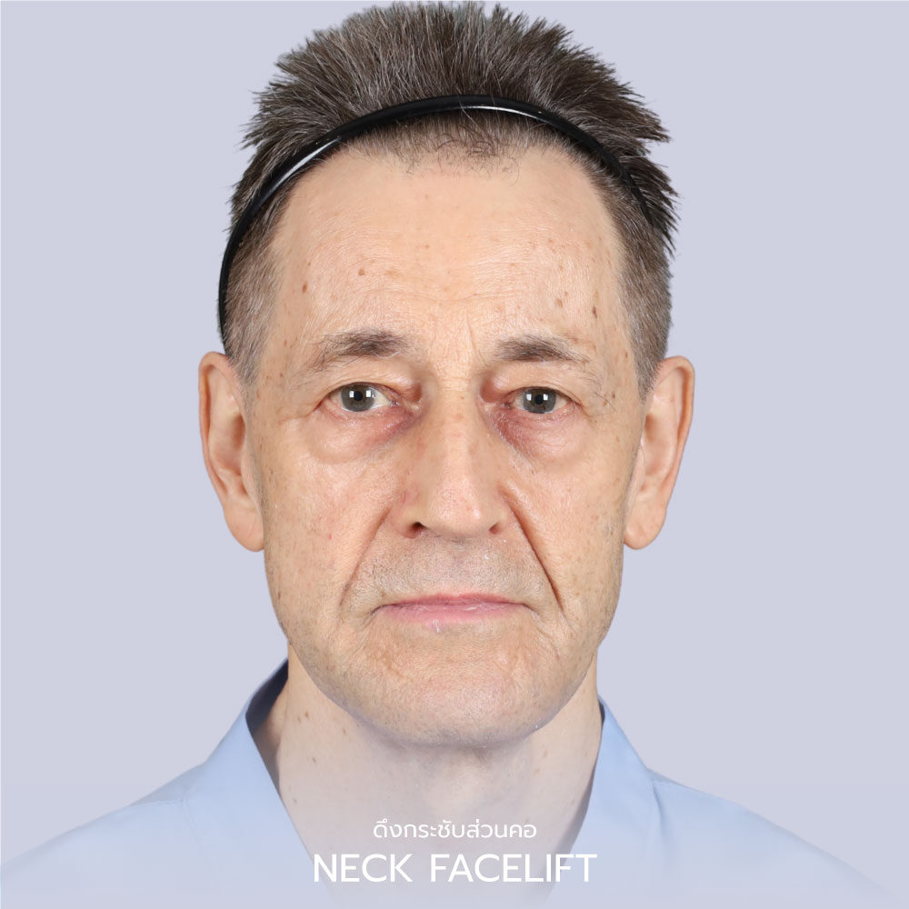 Necklift