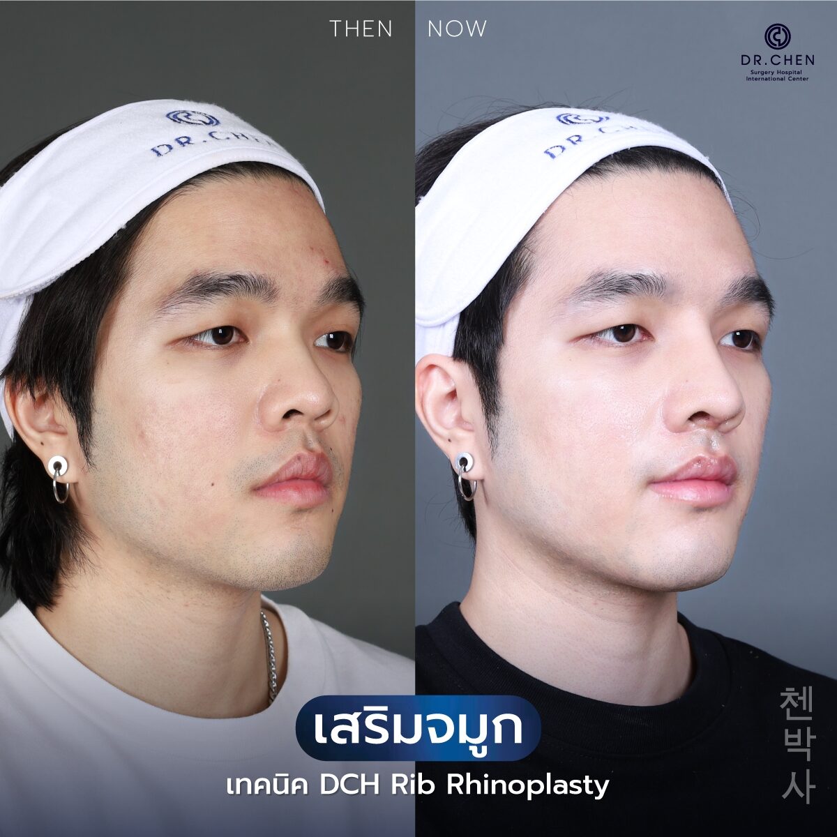 ________รีวิวจมูก-1-(5)_0