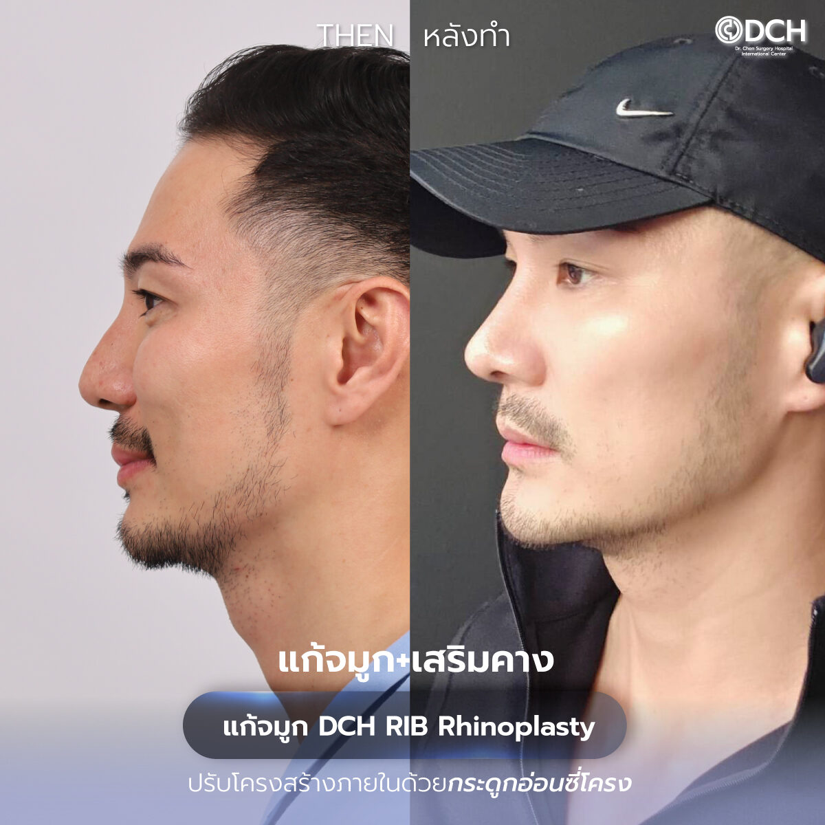 รีวิวจมูก-B-A-ลีโอ_0