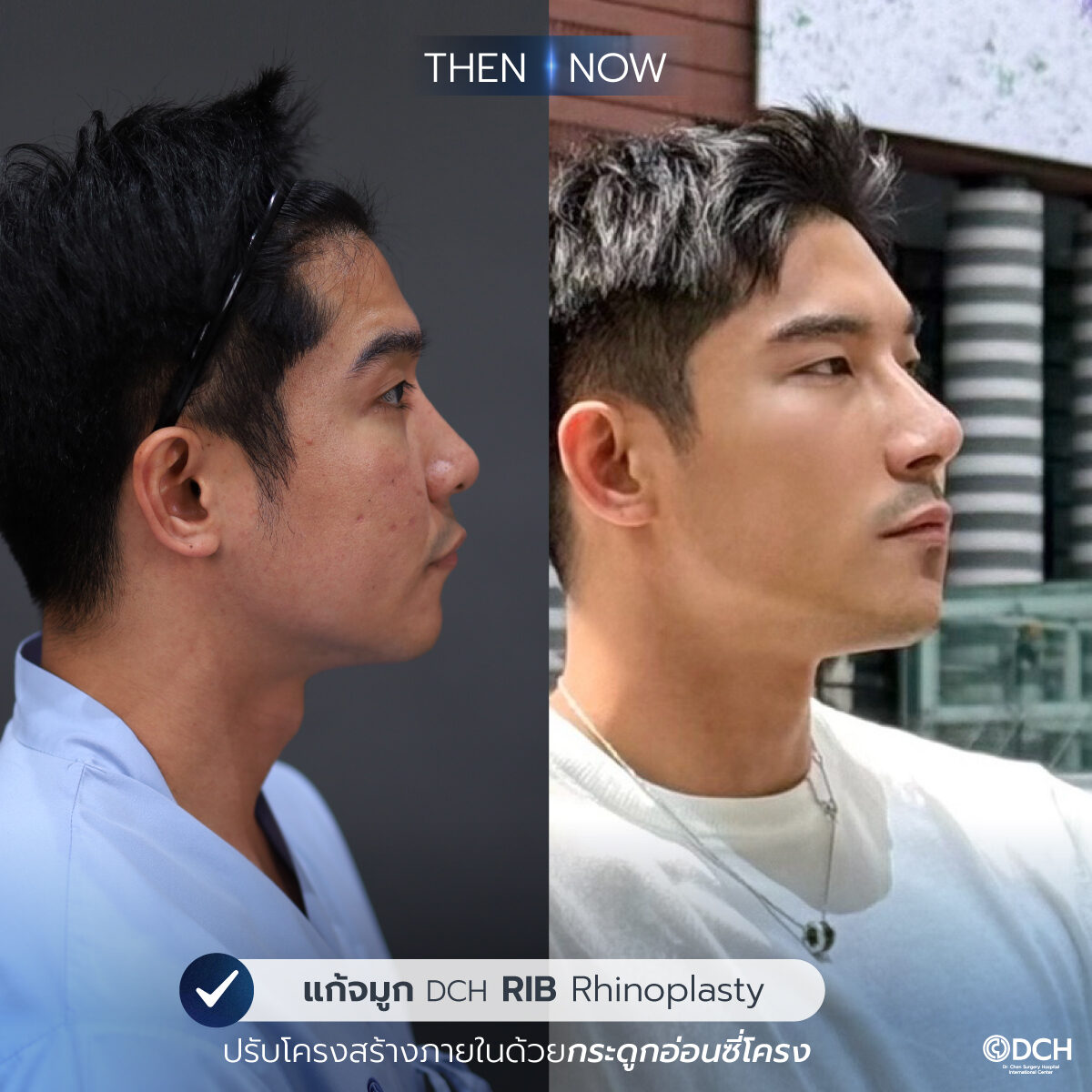 รีวิวจมูก-B-A-เคน1_0