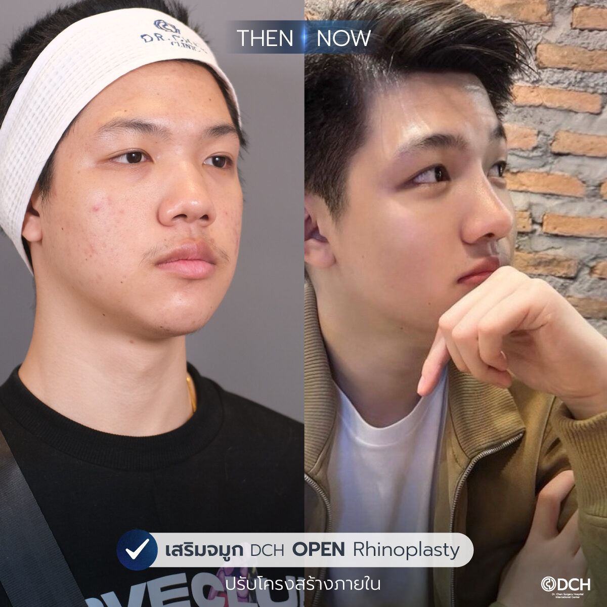 รีวิวจมูก-B-A-เอเจ_0