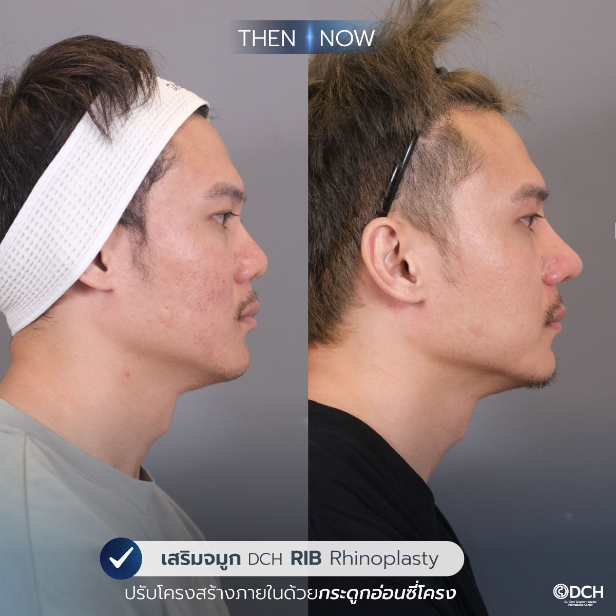 รีวิวจมูก-B-A-แทน2_0