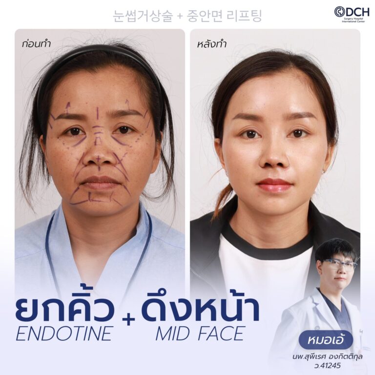 ยกคิ้ว EBL