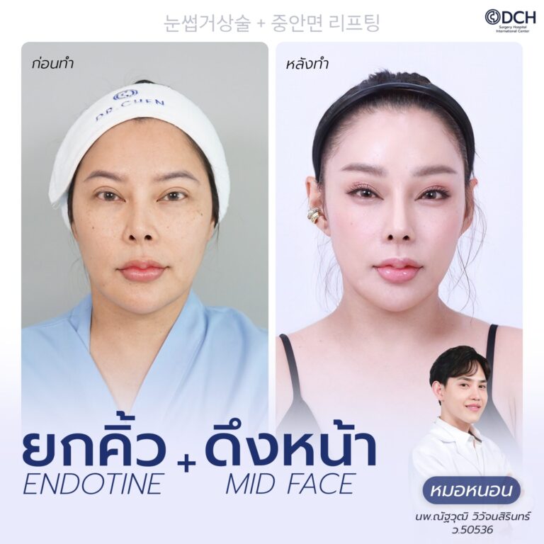 ยกคิ้ว EBL