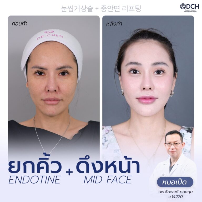 ยกคิ้ว EBL