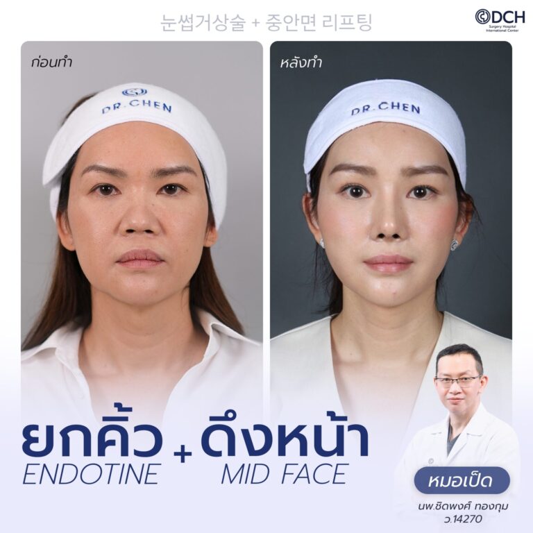 ยกคิ้ว EBL