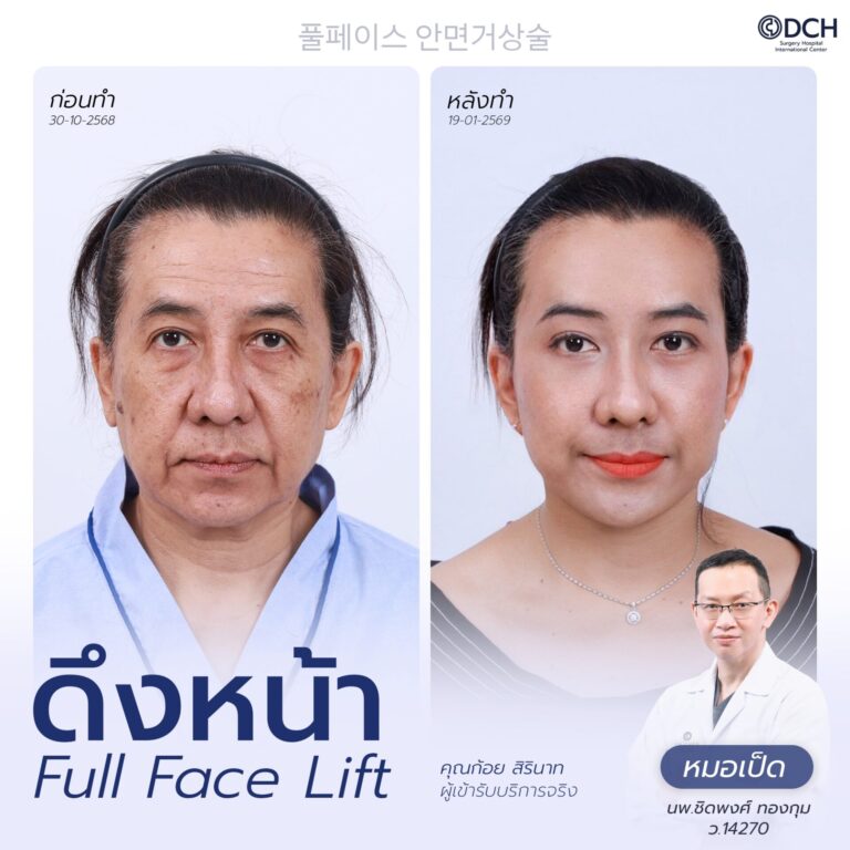 ดึงหน้า