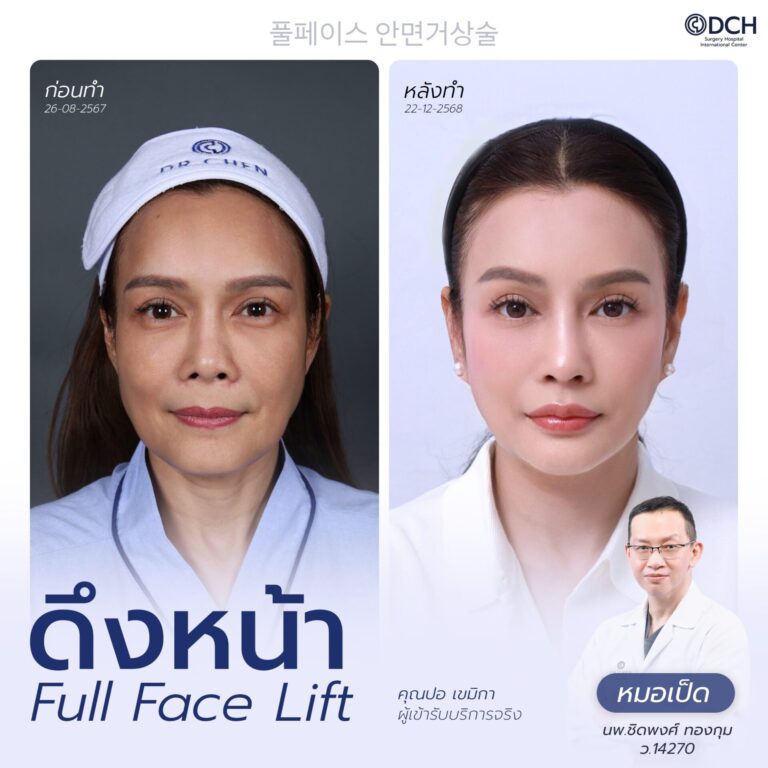 ดึงหน้า