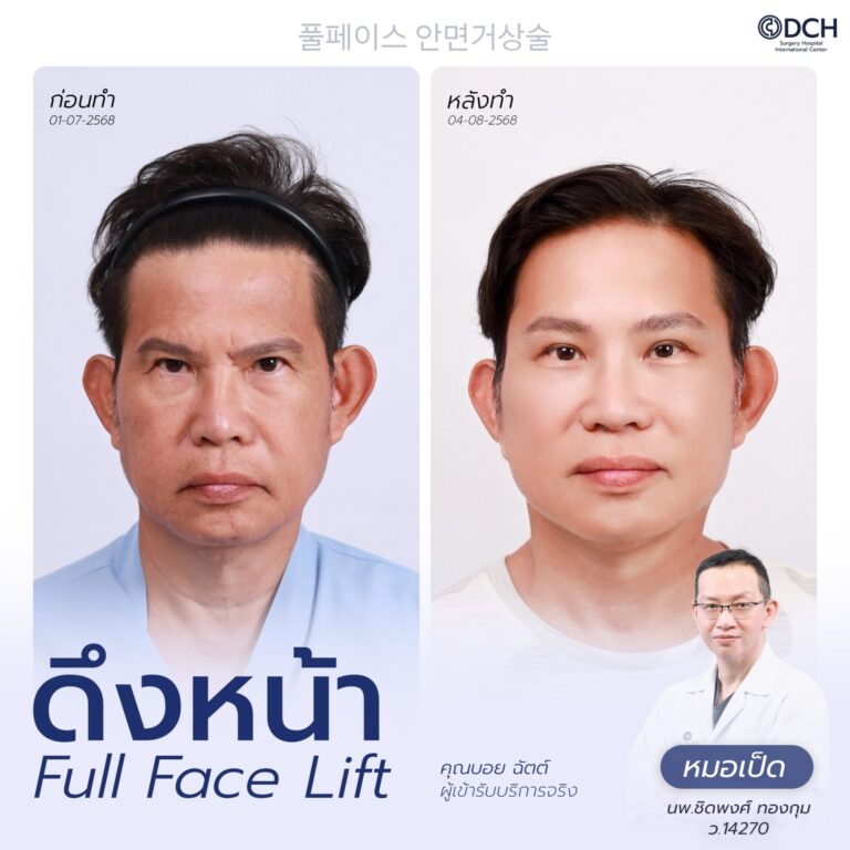 ดึงหน้า