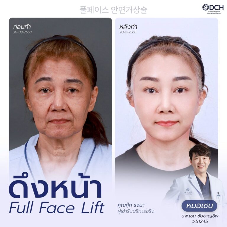 ดึงหน้า