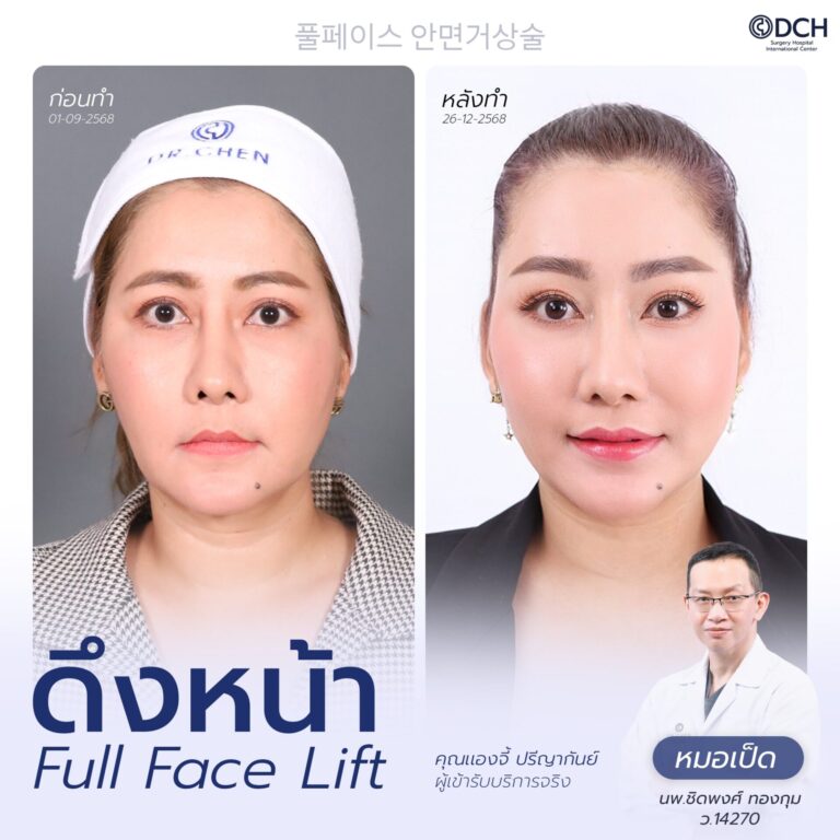 ดึงหน้า