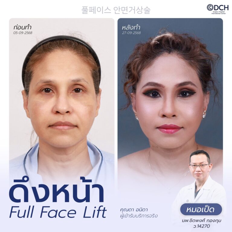 ดึงหน้า